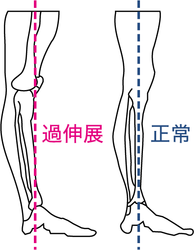 ひざの過伸展（左）と正常（右）のイメージ